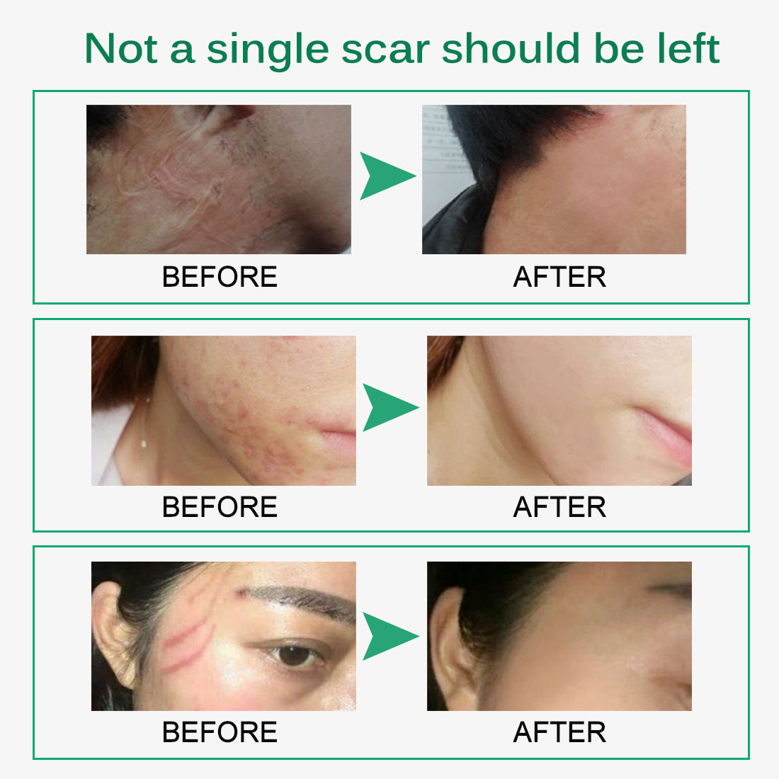 Skin Rebound Scarless Cream Scar Removal Cream Face Cream For Face Acn